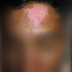 Before Treatment Leuccoderma