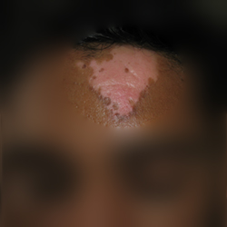 During Treatment 1 Leuccoderma