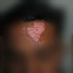 During Treatment 2 Leuccoderma