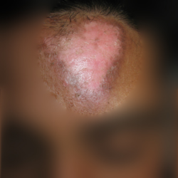 During Treatment 3 Leuccoderma