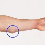 Eczema