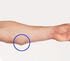 Lipoma bump on arm