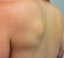 Lipoma on back