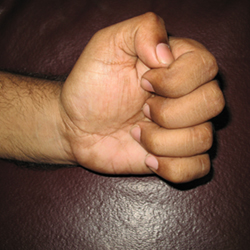 Before Treatment Paralytic Weakness