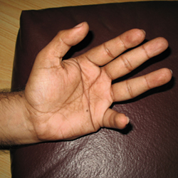 After Treatment Paralytic Weakness