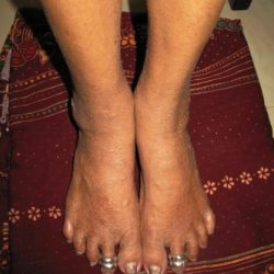 After Treatment Chronic Renal Failure
