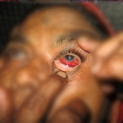 Before Treatment Conjuctivitis