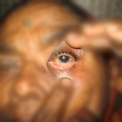After Treatment Conjuctivitis