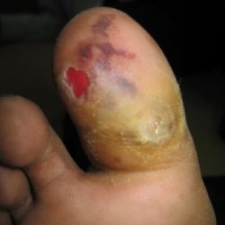 Before Treatment Diabetic Wound