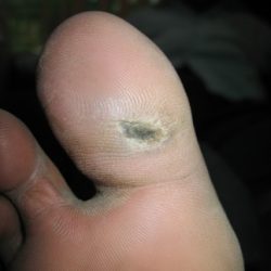 During Treatment 1 Diabetic Wound