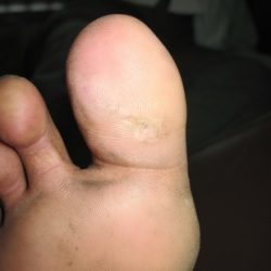 After Treatment Diabetic Wound