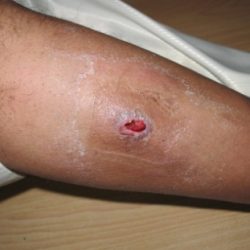 Before Treatment Diabetic Wound