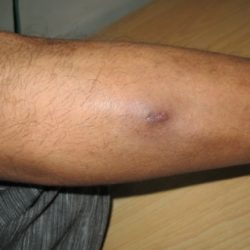 During Treatment 1 Diabetic Wound