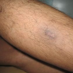 After Treatment Diabetic Wound