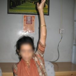 During Treatment Progress 3