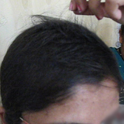 After Treatment Hair Fall