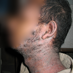 Before Treatment Psoriasis