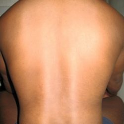 During Treatment 1 Psoriasis