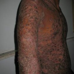 During Treatment 2 Psoriasis