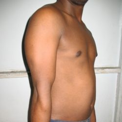 During Treatment 3 Psoriasis