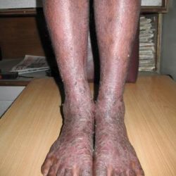Before Treatment Psoriasis