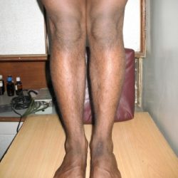 During Treatment 1 Psoriasis