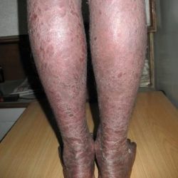 During Treatment 2 Psoriasis