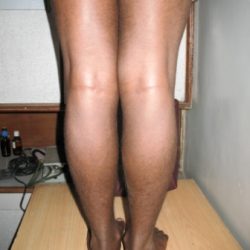 During Treatment 3 Psoriasis