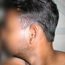 During Treatment 1 Psoriasis