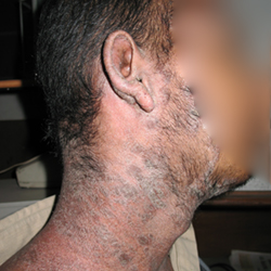 During Treatment 2 Psoriasis