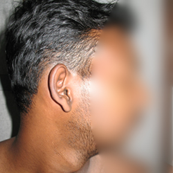 During Treatment 3 Psoriasis
