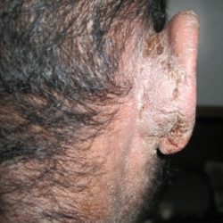 Before Treatment Psoriasis
