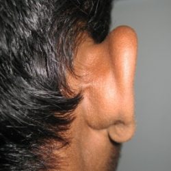 During Treatment 1 Psoriasis