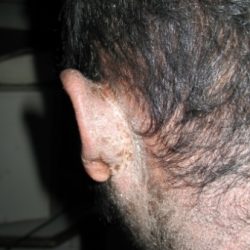 During Treatment 2 Psoriasis