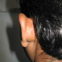 During Treatment 3 Psoriasis