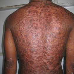 Before Treatment Psoriasis
