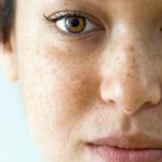 Pigmentation