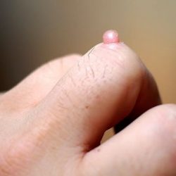Wart on Finger