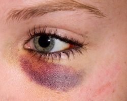 Dark Circles Close Up
