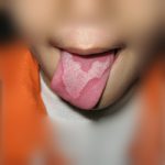 Before Treatment Stomatitis