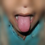 After Treatment Stomatitis