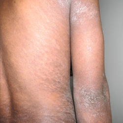 Skin disease treatment