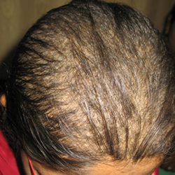 After Homeopathy Hair Fall Treatment in Pune