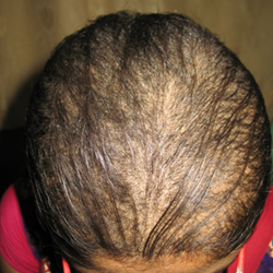 Before Homeopathy Hair Fall Treatment in Pune