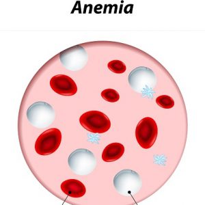 anemia