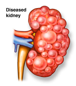 benign_kidney_diseases