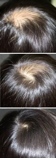 hair-growth treatment in pune