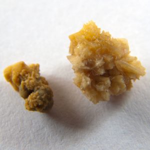 kidney-stones