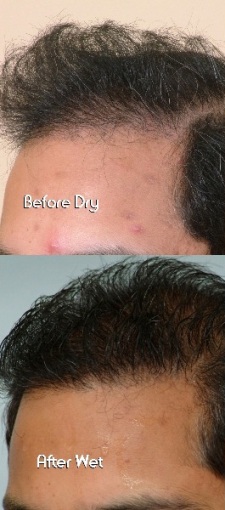 scalp treatment in hadapsar pune